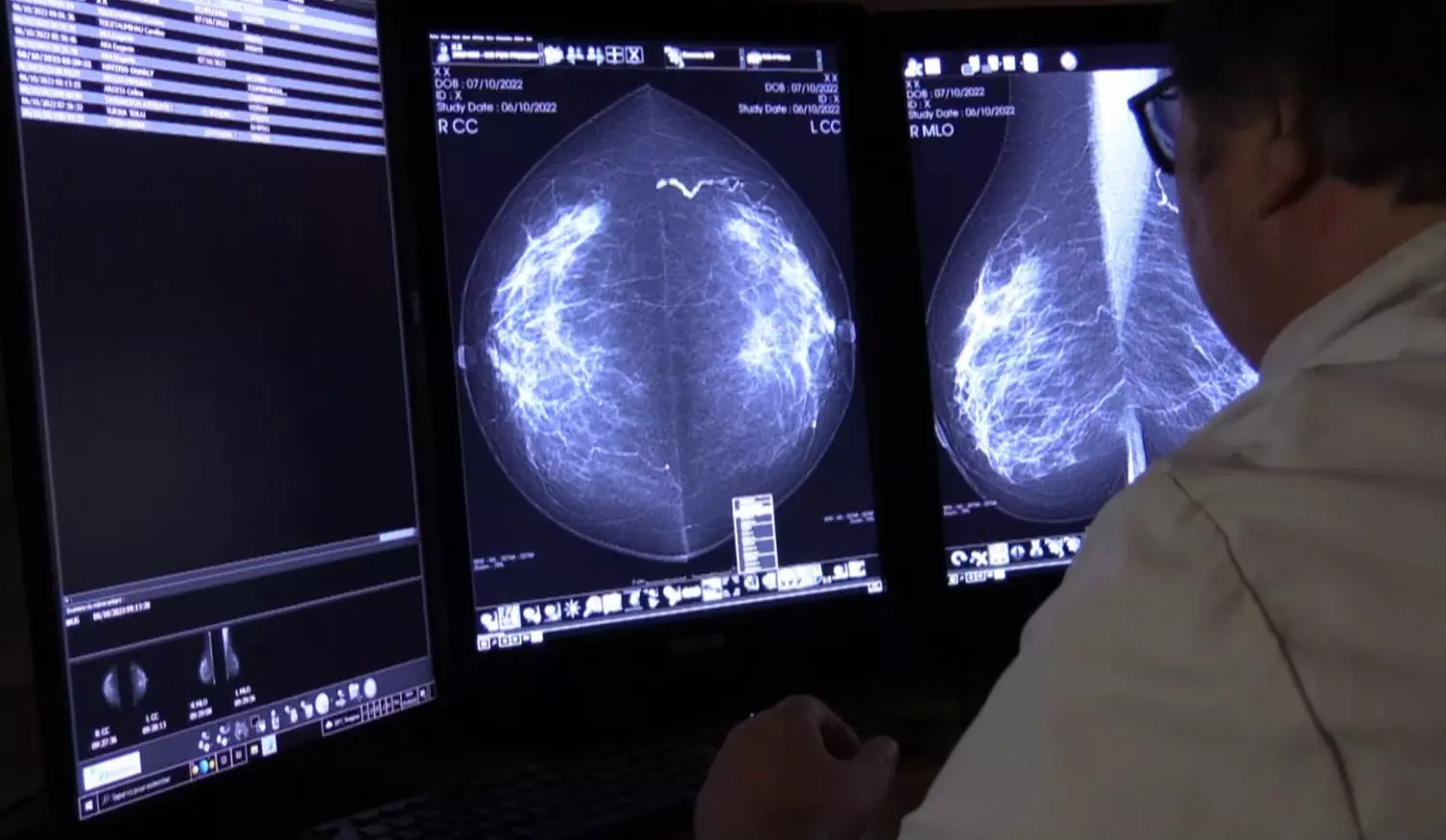 Cancer du sein : Le gouvernement de Polynésie va abaisser l’âge de dépistage gratuit à 45 ans pour toutes les femmes