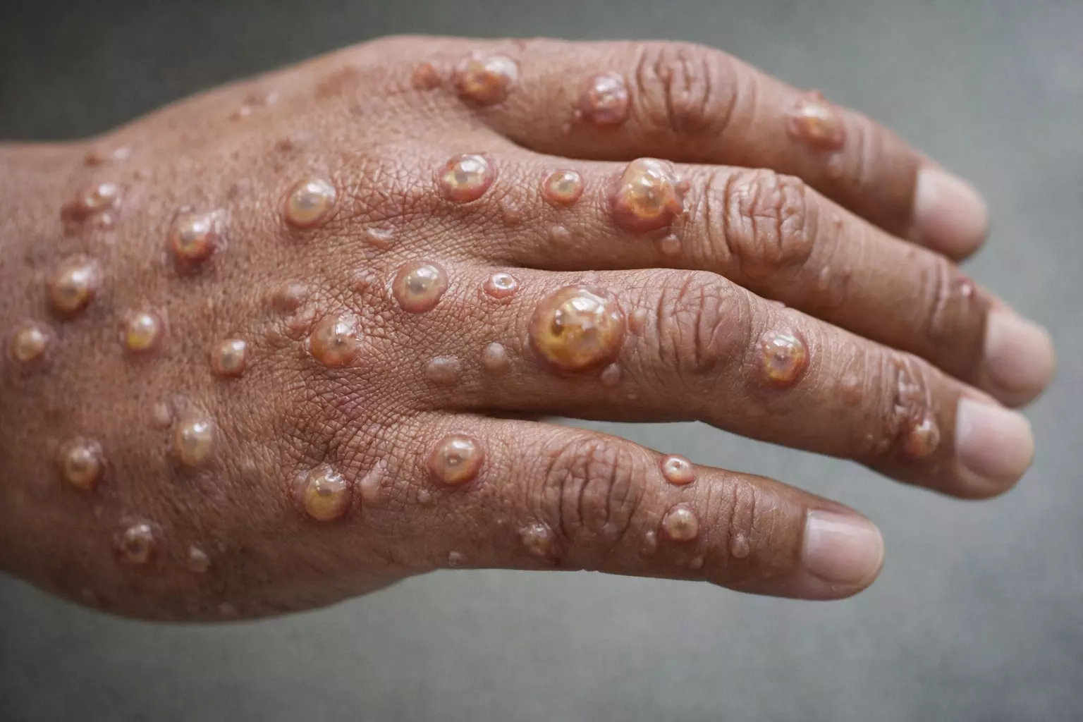 Un premier cas de Mpox confirmé à Mayotte