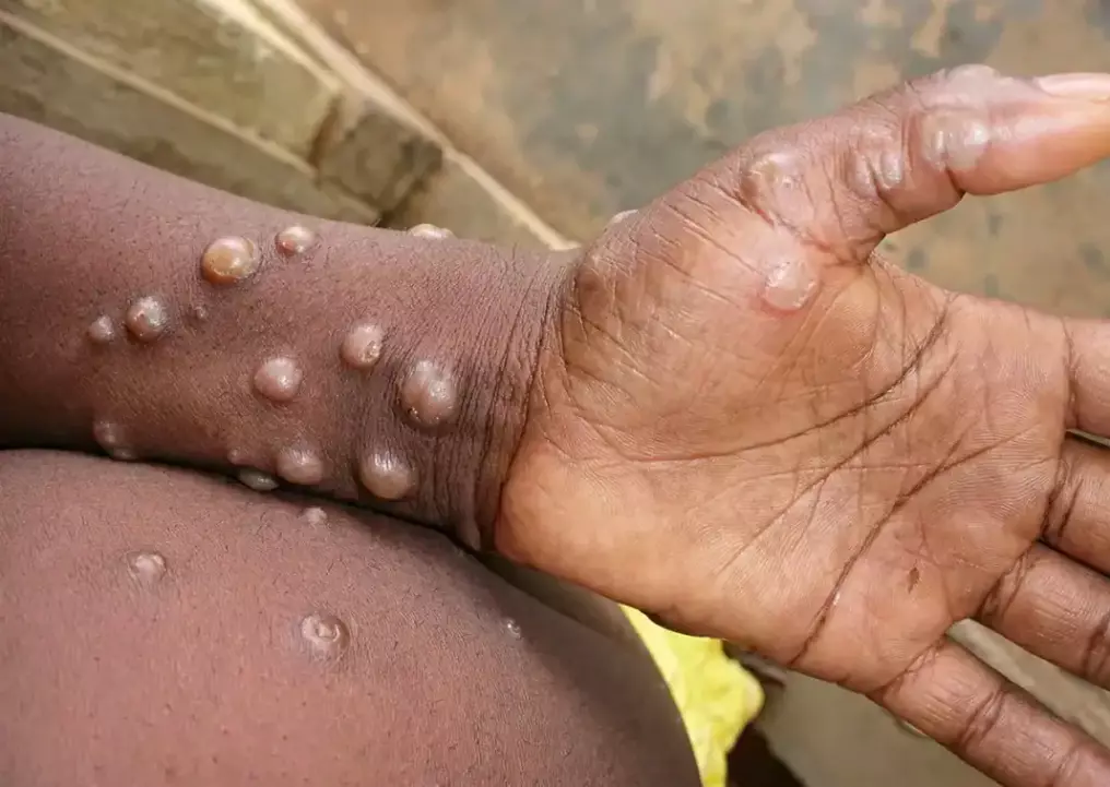 Neuf cas de mpox confirmés à Mayotte mais l'ARS juge la situation « peu inquiétante »