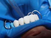 Martinique : Une première en implantologie dentaire après reconstruction osseuse au CHU de Martinique