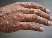Un premier cas de Mpox confirmé à Mayotte