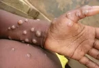 Neuf cas de mpox confirmés à Mayotte mais l'ARS juge la situation « peu inquiétante »
