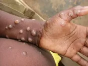 Neuf cas de mpox confirmés à Mayotte mais l'ARS juge la situation « peu inquiétante »